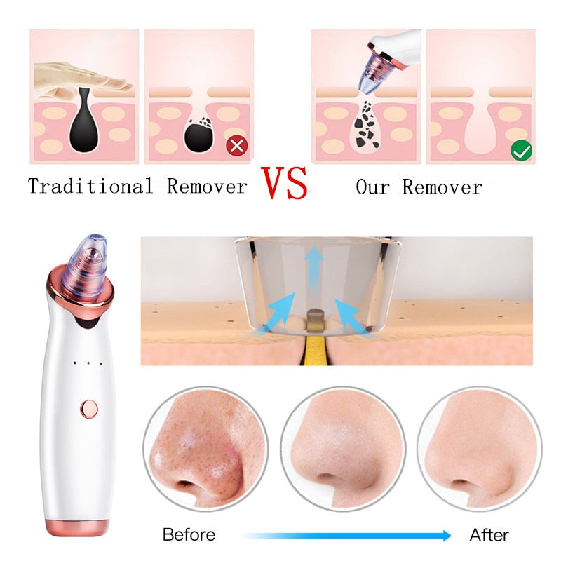 Electric Facial Blackhead Remover